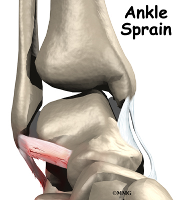 ankle sprain support