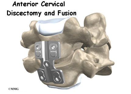 Complications After Cervical Spinal Fusion