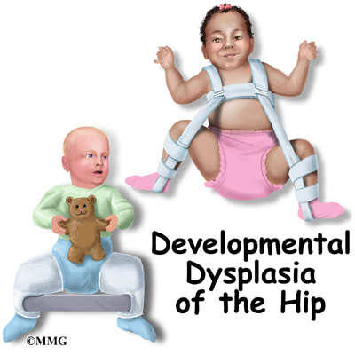 A Patient's Guide to Developmental Dysplasia of the Hip in Children
