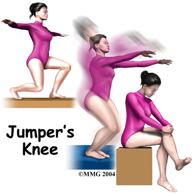 Jumpers Knee Support