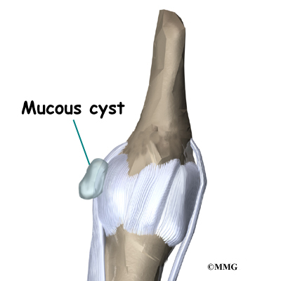 A mucous cyst is a type of ganglion, a small, harmless sac filled with a 