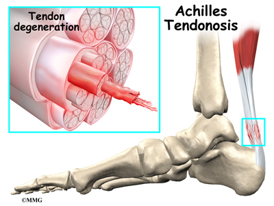 foot_achilles_tendon_causes02.jpg