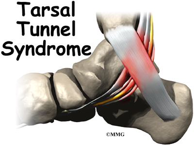 Tarsal Tunnel Syndrome | eOrthopod.com