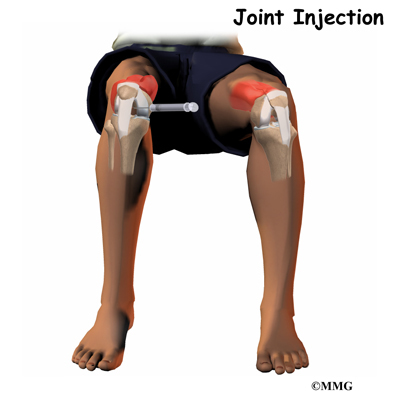 Steroids to help joints