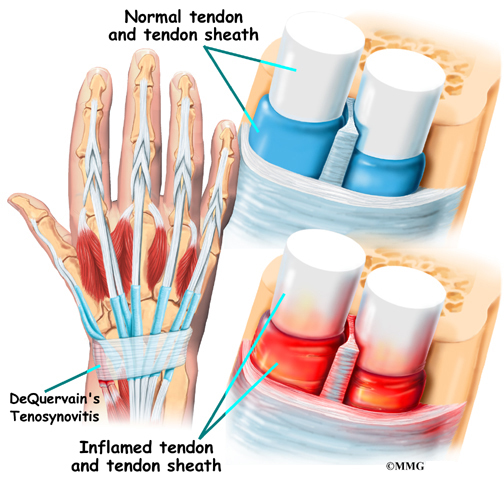 wrist tendonitis treatment