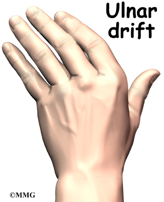 In rheumatoid arthritis, the fingers often become deformed as the disease 