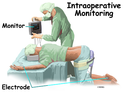 monitoring intraoperative surgery during spinal spine emg monitor placement eorthopod happens positioning used intraop sleep