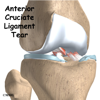 The Anterior Cruciate Ligament Injuries