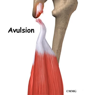 Knee Hamstring Injuries Anatomy: Avulsion