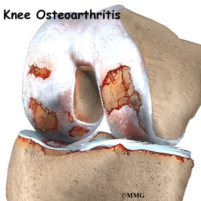  or wear and tear, arthritis. OA commonly affects the knee joint.