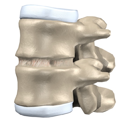  used to treat problems such as disc degeneration, spine instability, 