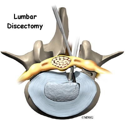 Discectomy Recovery