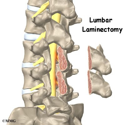 Lumbar Laminectomy | eOrthopod.com