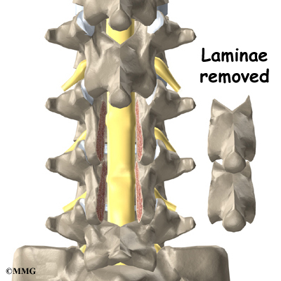 Lumbar Laminectomy | eOrthopod.com