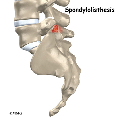 Spondylolisthesis - A Fancy Name For a Common Spine Problem