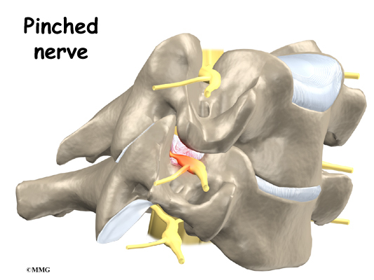 New Blog 1: Pinched Nerve In Neck