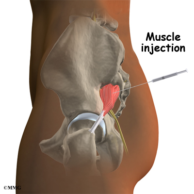 Pain after steroid injection in buttocks