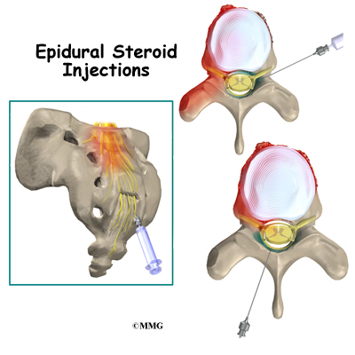 Epidural steroid injection in neck procedure