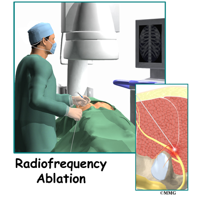 How Much Does An Ablation Procedure Cost