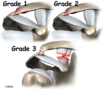Sprained Shoulder Ligament Treatment