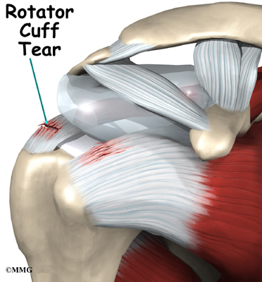 shoulder_rotator_cuff_symptoms01.jpg