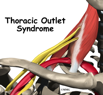 treating thoracic outlet syndrome