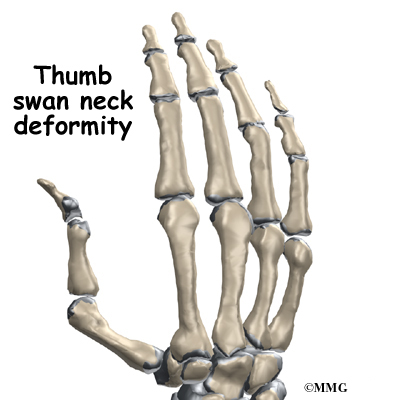 Moving the thumb away from the palm may become difficult.