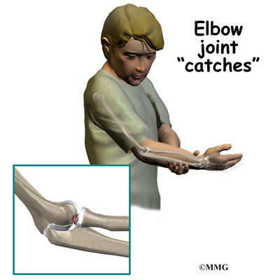 Adolescent Osteochondritis Dissecans Of The Elbow Orthogate