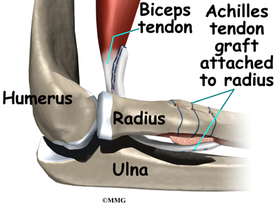 Distal biceps tendon tears (Elbow) - Adam Watson Orthopaedic Surgeon