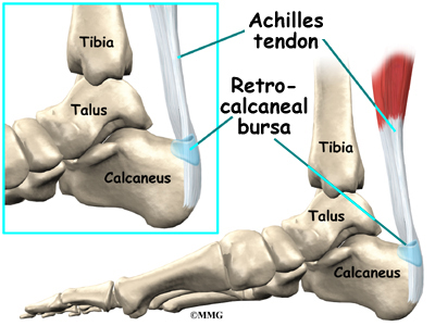 Haglund's Deformity and Your Feet: Causes, Symptoms & Treatment -  ePodiatrists