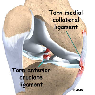 Can You Still Walk With A Torn Mcl Or Acl Patient Education Concord Orthopaedics