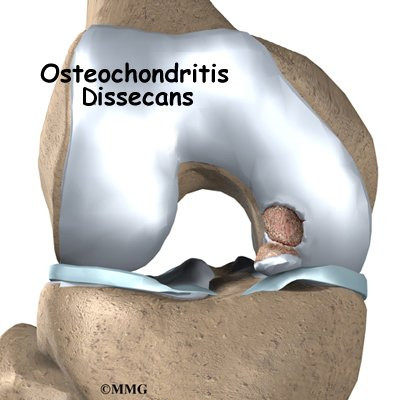 osteochondritis dissecans jelentése magyarul