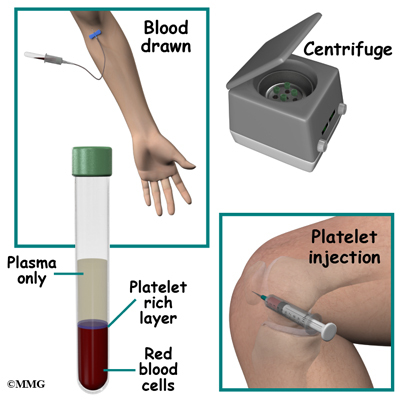 Image result for platelet rich plasma injections
